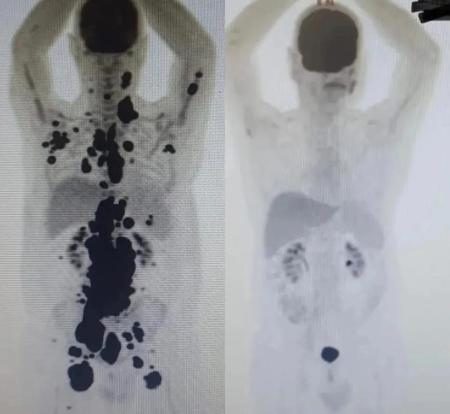 O publicit&aacute;rio Paulo Peregrino fez o tratamento CAR-T e ficou livre do c&acirc;ncer um m&ecirc;s ap&oacute;s receber a terapia inovadora