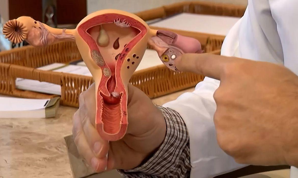 O C&acirc;ncer de colo de &uacute;tero &eacute; o terceiro lugar mais comum em mulheres, com uma m&eacute;dia de 17 mil casos por ano