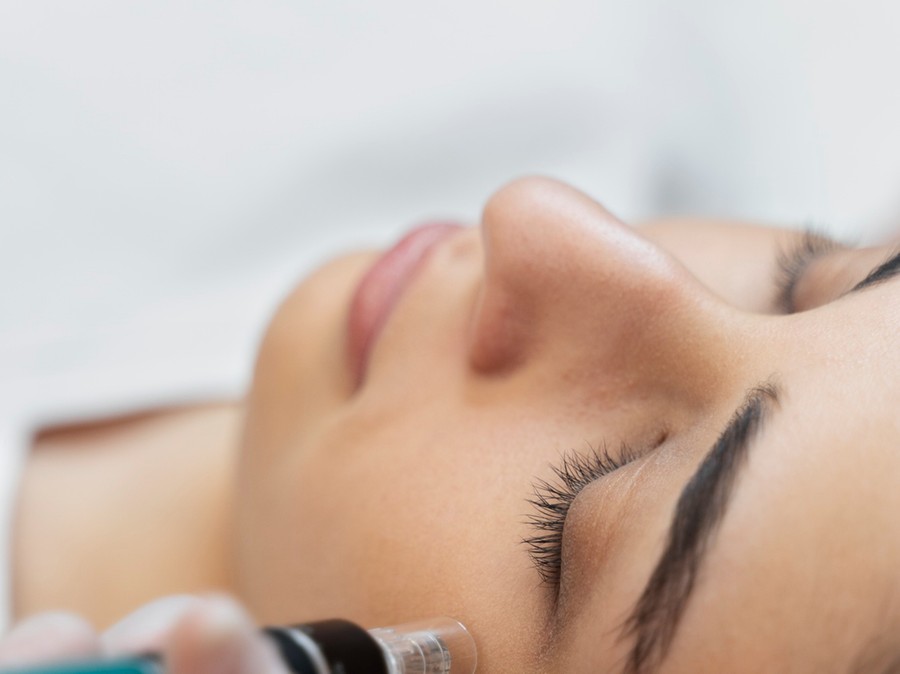 Bioestimulador de colágeno pode ser feito por meio de microagulhamento Bioestimulador de colágeno pode ser feito por meio de microagulhamento