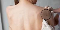 Proteger a pele dos raios UV são fundamentais para prevenir o melanoma e outros tumores de pele